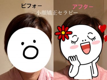 小顔・美顏矯正セラピー【小顔ビフォーアフター】若々しく可愛らしく変身しました〜!!!⭐︎小顔矯正サロン旭川ライフデザイン 大上奈美